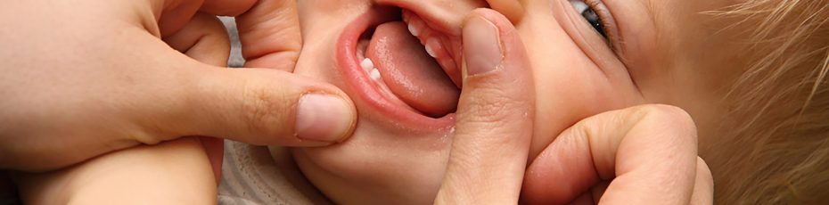 should an infants lip tie be treated